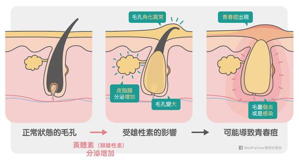 生理期 痘痘 